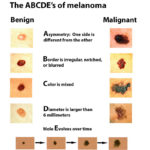 Melanoma-ABCDEs(1)