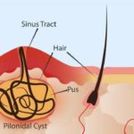 Pilonidal-Cyst-600×356