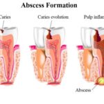 abscess-formation