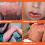 anaphylaxis_0
