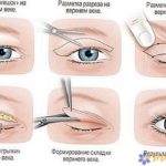 chto-takoe-transkonyuktivalnaya-blefaroplastika