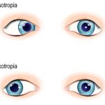 esotropiaexotropiaweb_4