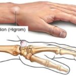 ganglion-higrom