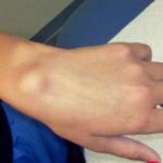 ganglion_na_ruci