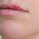 herpes