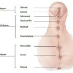 hypospadias