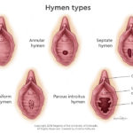 imperforate-hymen-type