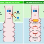 lactose-intolerance-640×493