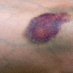 Bruise
