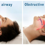 Snore problem concept. Illustration of normal airway and obstructive sleep apnea