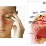 sinus