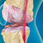 symptoms-and-treatment-of-patellofemoral-arthrosis