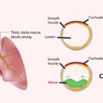 Cystic-Fibrosis-In-Children