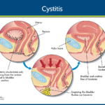CystitisCystitis-Infographic