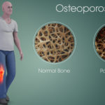 Male-Osteoporosis