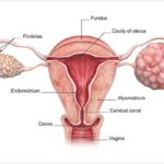 Ovarian-Cancer-Is-Not-a-Silent-Killer-722×406