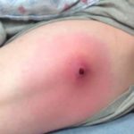 abscess-chto-eto-i-pochemu-voznikaet_2
