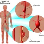 aneurysm_2