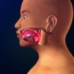 angioedema