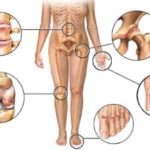 artritis