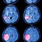 brain-tumor