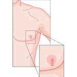breast-cancer-symptoms-in-men