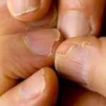 brittle_nails