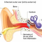 content_external_ear_infection