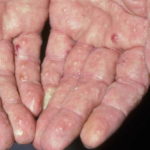 dermatof