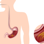 gastroskopije
