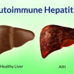 hepati