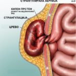 херн вклеш сл 3