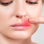 herpes2