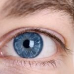 keratoconus