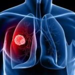 lung-cancer-screening