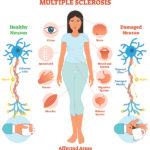 neuro-multiple-sclerosis-honorhealth