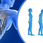 osteoporosis