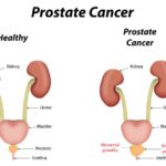 prostatecancer