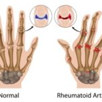 rheumatoid-arthritis-hands