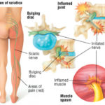 sciatica-final