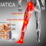 sciatica-pain-colorado-pain-care-blog