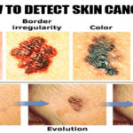 signs-of-skin-cancer