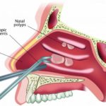 sinus_surgery-08-05-2018