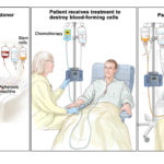 stem-cell-transplant-enlarge.__v900180807