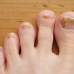 toenail-fungus-image-credit-pepsyrock-2010