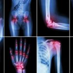 what-arthritis-pain-feels-like-722×406