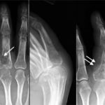 1Chondrosarcoma Pre-op Biopsy