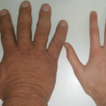 Akromegalijos-požymiai