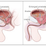 CDR462221 benign prostatic hyperplasia