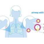 Bronchiectasis_lung-diagram-0317